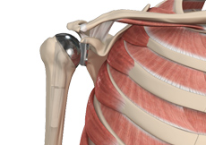 Conventional Shoulder Replacement